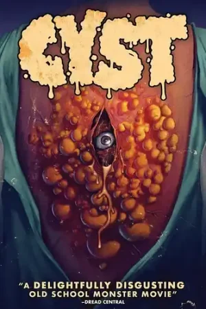 Popular Cyst / (Sub)